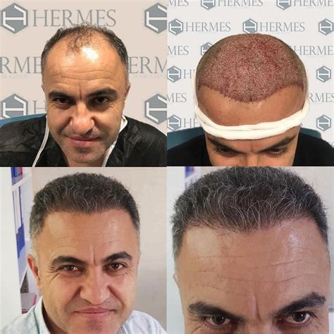 hermes hair clinic yorumları|hermes hair clinic istanbul.